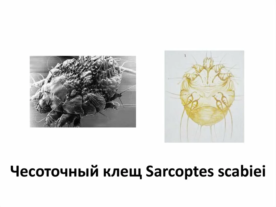 The role of public health initiatives in controlling Sarcoptes scabiei outbreaks